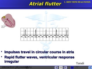 interactive physiologyECG
Taradi
77
Atrial flutterAtrial flutter
 Impulses travel in circular course in atriaImpulses travel in circular course in atria
 Rapid flutter waves, ventricular responseRapid flutter waves, ventricular response
irregularirregular
1.1. RHYTHM DIAGNOSISRHYTHM DIAGNOSIS
 