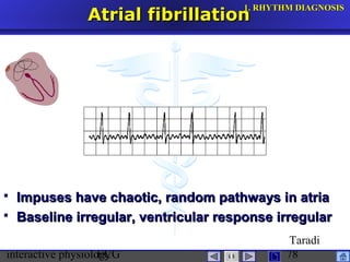 interactive physiologyECG
Taradi
78
Atrial fibrillationAtrial fibrillation
 Impuses have chaotic, random pathways in atriaImpuses have chaotic, random pathways in atria
 Baseline irregular, ventricular response irregularBaseline irregular, ventricular response irregular
1.1. RHYTHM DIAGNOSISRHYTHM DIAGNOSIS
 