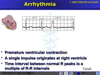 interactive physiologyECG
Taradi
80
ArrhythmiaArrhythmia
 Premature ventricular contractionPremature ventricular contraction
 A single impulse originates at right ventricleA single impulse originates at right ventricle
 Time interval between normal R peaks is aTime interval between normal R peaks is a
multiple of R-R intervalsmultiple of R-R intervals
1.1. RHYTHM DIAGNOSISRHYTHM DIAGNOSIS
 