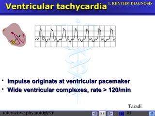 interactive physiologyECG
Taradi
81
Ventricular tachycardiaVentricular tachycardia
 Impulse originate at ventricular pacemakerImpulse originate at ventricular pacemaker
 Wide ventricular complexes, rate > 120/minWide ventricular complexes, rate > 120/min
1.1. RHYTHM DIAGNOSISRHYTHM DIAGNOSIS
 