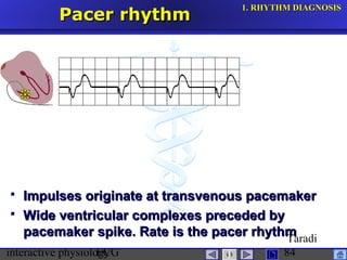 interactive physiologyECG
Taradi
84
Pacer rhythmPacer rhythm
 Impulses originate at transvenous pacemakerImpulses originate at transvenous pacemaker
 Wide ventricular complexes preceded byWide ventricular complexes preceded by
pacemaker spike. Rate is the pacer rhythmpacemaker spike. Rate is the pacer rhythm
1.1. RHYTHM DIAGNOSISRHYTHM DIAGNOSIS
 