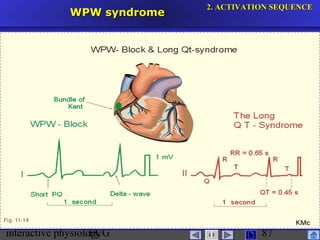 interactive physiologyECG
Taradi
87
WPW syndromeWPW syndrome
2.2. ACTIVATION SEQUENCEACTIVATION SEQUENCE
 