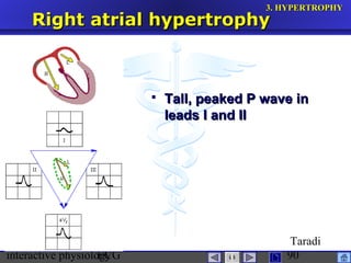 interactive physiologyECG
Taradi
90
Right atrial hypertrophyRight atrial hypertrophy
 Tall, peaked P wave inTall, peaked P wave in
leads I and IIleads I and II
3.3. HYPERTROPHYHYPERTROPHY
 