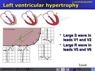 interactive physiologyECG
Taradi
92
Left ventricular hypertrophyLeft ventricular hypertrophy
 Large S wave inLarge S wave in
leads V1 and V2leads V1 and V2
 Large R wave inLarge R wave in
leads V5 and V6leads V5 and V6
3.3. HYPERTROPHYHYPERTROPHY
 