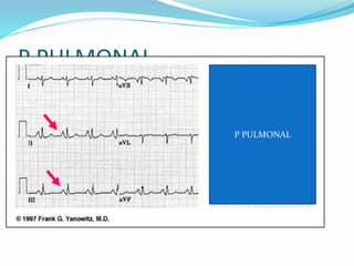 P PULMONAL
P PULMONAL
 