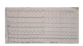 EKG_INTERPRETATION.pptx.pdf