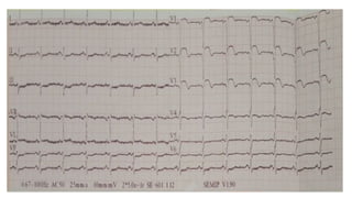 EKG_INTERPRETATION.pptx.pdf