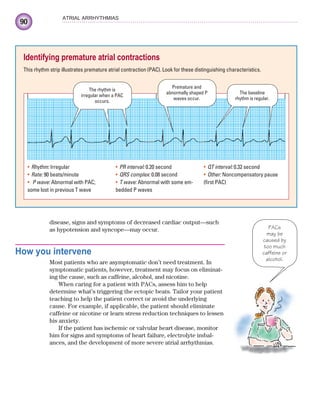 90
ATRIAL ARRHYTHMIAS
disease, signs and symptoms of decreased cardiac output—such
as hypotension and syncope—may occur.
How you intervene
Most patients who are asymptomatic don’t need treatment. In
symptomatic patients, however, treatment may focus on eliminat-
ing the cause, such as caffeine, alcohol, and nicotine.
When caring for a patient with PACs, assess him to help
determine what’s triggering the ectopic beats. Tailor your patient
teaching to help the patient correct or avoid the underlying
cause. For example, if applicable, the patient should eliminate
caffeine or nicotine or learn stress reduction techniques to lessen
his anxiety.
If the patient has ischemic or valvular heart disease, monitor
him for signs and symptoms of heart failure, electrolyte imbal-
ances, and the development of more severe atrial arrhythmias.
Identifying premature atrial contractions
This rhythm strip illustrates premature atrial contraction (PAC). Look for these distinguishing characteristics.
Rhythm:
• Irregular
Rate:
• 90 beats/minute
P wave:
• Abnormal with PAC;
some lost in previous T wave
PR interval:
• 0.20 second
QRS complex:
• 0.08 second
T wave:
• Abnormal with some em-
bedded P waves
QT interval:
• 0.32 second
Other:
• Noncompensatory pause
(first PAC)
The rhythm is
irregular when a PAC
occurs.
Premature and
abnormally shaped P
waves occur.
The baseline
rhythm is regular.
PACs
may be
caused by
too much
caffeine or
alcohol.
ECG_Chap05.indd 90
ECG_Chap05.indd 90 7/8/2010 12:32:30 PM
7/8/2010 12:32:30 PM
 