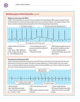 94
ATRIAL ARRHYTHMIAS
Identifying types of atrial tachycardia (continued)
Multifocal atrial tachycardia (MAT)
In MAT, atrial tachycardia occurs with numerous atrial foci firing intermittently. MAT produces varying P waves
on the strip and occurs most commonly in patients with chronic pulmonary disease. The irregular baseline in this
strip is caused by movement of the chest wall. Look for these distinguishing characteristics.
The rhythm is irregular. The rate is greater than 100 beats/minute.
The configuration of the P wave varies.
Rhythm:
• Atrial and ventricular—
irregular
Rate:
• Atrial—100 to 250 beats/
minute, usually under 160; ventricu-
lar—101 to 250 beats/minute
P wave:
• Configuration varies;
must see at least three different P
wave shapes
PR interval:
• Variable
QRS Complex:
• Usually normal; can
be aberrant if arrhythmia persists
T wave:
• Usually distorted
QT interval:
• Possibly indiscernible
Other:
• None
The rate is 150 to
250 beats/minute.
The rhythm is regular.
The arrhythmia comes on suddenly;
in this case, from a PAC.
Paroxysmal atrial tachycardia (PAT)
A type of paroxysmal supraventricular tachycardia, PAT features brief periods of tachycardia that alternate
with periods of normal sinus rhythm. PAT starts and stops suddenly as a result of rapid firing of an ectopic
focus. It commonly follows frequent premature atrial contractions (PACs), one of which initiates the tachycar-
dia. Look for these distinguishing characteristics.
Rhythm:
• Regular
Rate:
• 150 to 250 beats/minute
P wave:
• Abnormal, possibly hid-
den in previous T wave
PR interval:
• Identical for each
cycle
QRS complex:
• Possibly aberrantly
conducted
T wave:
• Usually distorted
QT interval:
• Possibly indiscernible
Other:
• One P wave for each QRS
complex
ECG_Chap05.indd 94
ECG_Chap05.indd 94 7/8/2010 12:32:33 PM
7/8/2010 12:32:33 PM
 