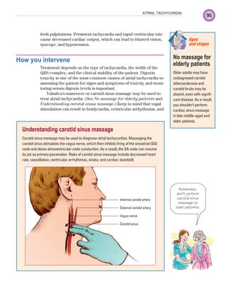 95
ATRIAL TACHYCARDIA
feels palpitations. Persistent tachycardia and rapid ventricular rate
cause decreased cardiac output, which can lead to blurred vision,
syncope, and hypotension.
How you intervene
Treatment depends on the type of tachycardia, the width of the
QRS complex, and the clinical stability of the patient. Digoxin
toxicity is one of the most common causes of atrial tachycardia so
assessing the patient for signs and symptoms of toxicity and moni-
toring serum digoxin levels is important.
Valsalva’s maneuver or carotid sinus massage may be used to
treat atrial tachycardia. (See No massage for elderly patients and
Understanding carotid sinus massage.) Keep in mind that vagal
stimulation can result in bradycardia, ventricular arrhythmias, and
Understanding carotid sinus massage
Carotid sinus massage may be used to diagnose atrial tachycardias. Massaging the
carotid sinus stimulates the vagus nerve, which then inhibits firing of the sinoatrial (SA)
node and slows atrioventricular node conduction. As a result, the SA node can resume
its job as primary pacemaker. Risks of carotid sinus massage include decreased heart
rate, vasodilation, ventricular arrhythmias, stroke, and cardiac standstill.
Internal carotid artery
External carotid artery
Vagus nerve
Carotid sinus
No massage for
elderly patients
Older adults may have
undiagnosed carotid
atherosclerosis and
carotid bruits may be
absent, even with signifi-
cant disease. As a result,
you shouldn’t perform
cardiac sinus massage
in late middle-aged and
older patients.
Ages
and stages
Remember,
don’t perform
carotid sinus
massage on
older patients.
ECG_Chap05.indd 95
ECG_Chap05.indd 95 7/8/2010 12:32:33 PM
7/8/2010 12:32:33 PM
 
