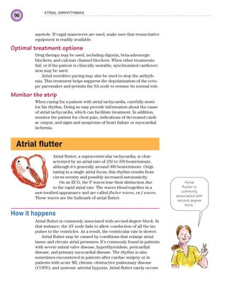 96
ATRIAL ARRHYTHMIAS
asystole. If vagal maneuvers are used, make sure that resuscitative
equipment is readily available.
Optimal treatment options
Drug therapy may be used, including digoxin, beta-adrenergic
blockers, and calcium channel blockers. When other treatments
fail, or if the patient is clinically unstable, synchronized cardiover-
sion may be used.
Atrial overdrive pacing may also be used to stop the arrhyth-
mia. This treatment helps suppress the depolarization of the ecto-
pic pacemaker and permits the SA node to resume its normal role.
Monitor the strip
When caring for a patient with atrial tachycardia, carefully moni-
tor his rhythm. Doing so may provide information about the cause
of atrial tachycardia, which can facilitate treatment. In addition,
monitor the patient for chest pain, indications of decreased cardi-
ac output, and signs and symptoms of heart failure or myocardial
ischemia.
Atrial flutter
Atrial flutter, a supraventricular tachycardia, is char-
acterized by an atrial rate of 250 to 350 beats/minute,
although it’s generally around 300 beats/minute. Origi-
nating in a single atrial focus, this rhythm results from
circus reentry and possibly increased automaticity.
On an ECG, the P waves lose their distinction due
to the rapid atrial rate. The waves blend together in a
saw-toothed appearance and are called flutter waves, or f waves.
These waves are the hallmark of atrial flutter.
How it happens
Atrial flutter is commonly associated with second-degree block. In
that instance, the AV node fails to allow conduction of all the im-
pulses to the ventricles. As a result, the ventricular rate is slower.
Atrial flutter may be caused by conditions that enlarge atrial
tissue and elevate atrial pressures. It’s commonly found in patients
with severe mitral valve disease, hyperthyroidism, pericardial
disease, and primary myocardial disease. The rhythm is also
sometimes encountered in patients after cardiac surgery or in
patients with acute MI, chronic obstructive pulmonary disease
(COPD), and systemic arterial hypoxia. Atrial flutter rarely occurs
Atrial
flutter is
commonly
associated with
second-degree
block.
ECG_Chap05.indd 96
ECG_Chap05.indd 96 7/8/2010 12:32:35 PM
7/8/2010 12:32:35 PM
 