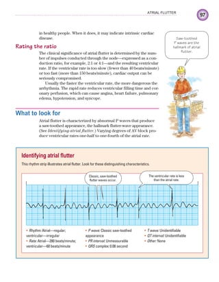 97
ATRIAL FLUTTER
in healthy people. When it does, it may indicate intrinsic cardiac
disease.
Rating the ratio
The clinical significance of atrial flutter is determined by the num-
ber of impulses conducted through the node—expressed as a con-
duction ratio, for example, 2:1 or 4:1—and the resulting ventricular
rate. If the ventricular rate is too slow (fewer than 40 beats/minute)
or too fast (more than 150 beats/minute), cardiac output can be
seriously compromised.
Usually the faster the ventricular rate, the more dangerous the
arrhythmia. The rapid rate reduces ventricular filling time and cor-
onary perfusion, which can cause angina, heart failure, pulmonary
edema, hypotension, and syncope.
What to look for
Atrial flutter is characterized by abnormal P waves that produce
a saw-toothed appearance, the hallmark flutter-wave appearance.
(See Identifying atrial flutter.) Varying degrees of AV block pro-
duce ventricular rates one-half to one-fourth of the atrial rate.
Identifying atrial flutter
This rhythm strip illustrates atrial flutter. Look for these distinguishing characteristics.
The ventricular rate is less
than the atrial rate.
Classic, saw-toothed
flutter waves occur.
Rhythm:
• Atrial—regular;
ventricular—irregular
Rate:
• Atrial—280 beats/minute;
ventricular—60 beats/minute
P wave:
• Classic saw-toothed
appearance
PR interval:
• Unmeasurable
QRS complex:
• 0.08 second
T wave:
• Unidentifiable
QT interval:
• Unidentifiable
Other:
• None
Saw-toothed
P waves are the
hallmark of atrial
flutter.
ECG_Chap05.indd 97
ECG_Chap05.indd 97 7/8/2010 12:32:36 PM
7/8/2010 12:32:36 PM
 
