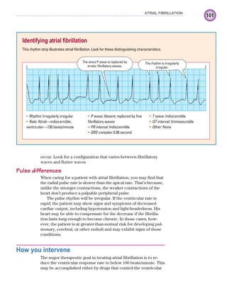 101
ATRIAL FIBRILLATION
occur. Look for a configuration that varies between fibrillatory
waves and flutter waves.
Pulse differences
When caring for a patient with atrial fibrillation, you may find that
the radial pulse rate is slower than the apical rate. That’s because,
unlike the stronger contractions, the weaker contractions of the
heart don’t produce a palpable peripheral pulse.
The pulse rhythm will be irregular. If the ventricular rate is
rapid, the patient may show signs and symptoms of decreased
cardiac output, including hypotension and light-headedness. His
heart may be able to compensate for the decrease if the fibrilla-
tion lasts long enough to become chronic. In those cases, how-
ever, the patient is at greater-than-normal risk for developing pul-
monary, cerebral, or other emboli and may exhibit signs of those
conditions.
How you intervene
The major therapeutic goal in treating atrial fibrillation is to re-
duce the ventricular response rate to below 100 beats/minute. This
may be accomplished either by drugs that control the ventricular
Identifying atrial fibrillation
This rhythm strip illustrates atrial fibrillation. Look for these distinguishing characteristics.
The sinus P wave is replaced by
erratic fibrillatory waves.
The rhythm is irregularly
irregular.
Rhythm:
• Irregularly irregular
Rate:
• Atrial—indiscernible;
ventricular—130 beats/minute
P wave:
• Absent; replaced by fine
fibrillatory waves
PR interval:
• Indiscernible
QRS complex:
• 0.08 second
T wave:
• Indiscernible
QT interval:
• Unmeasurable
Other:
• None
ECG_Chap05.indd 101
ECG_Chap05.indd 101 7/8/2010 12:32:39 PM
7/8/2010 12:32:39 PM
 