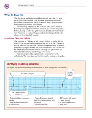104
ATRIAL ARRHYTHMIAS
What to look for
The rhythm on an ECG strip will look slightly irregular because
sites of impulse initiation vary. The rate is usually normal—60
to 100 beats/minute—but it may be slower. The P waves change
shape as the pacemaker site changes.
Impulses may originate in the SA node, atria, or AV junction.
If an impulse originates in the AV junction, the P wave may come
before, during, or after the QRS complex. The PR interval will also
vary from beat to beat as the pacemaker site changes, but it will
always be less than 0.20 second.
Mind the PRs and QRSs
The variation in PR interval will cause a slightly irregular R-R in-
terval. If the impulse originates in the AV junction, the PR interval
will be less than 0.12 second. Ventricular depolarization is normal,
so the QRS complex will be less than 0.12 second. The T wave and
QT interval will usually be normal, although the QT interval can
vary. (See Identifying wandering pacemaker.)
Patients are generally asymptomatic and unaware of the
arrhythmia. The pulse rate and rhythm may be normal or irregular.
Identifying wandering pacemaker
This rhythm strip illustrates wandering pacemaker. Look for these distinguishing characteristics.
The rhythm is irregular.
The P waves change in
appearance.
The QRS
complex is
normal.
Rhythm:
• Atrial and ventricular—
irregular
Rate:
• Atrial and ventricular—
50 beats/minute
P wave:
• Changes in size and
shape; first P wave inverted, sec-
ond upright
PR interval:
• Variable
QRS complex:
• 0.08 second
T wave:
• Normal
QT interval:
• 0.44 second
Other:
• None
ECG_Chap05.indd 104
ECG_Chap05.indd 104 7/8/2010 12:32:41 PM
7/8/2010 12:32:41 PM
 
