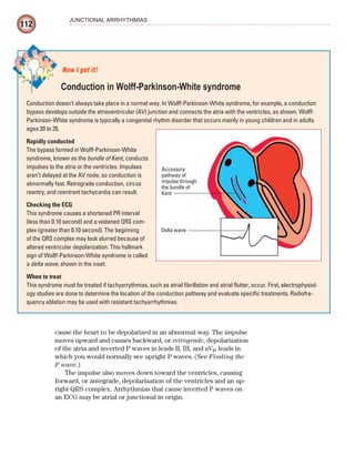 112
JUNCTIONAL ARRHYTHMIAS
cause the heart to be depolarized in an abnormal way. The impulse
moves upward and causes backward, or retrograde, depolarization
of the atria and inverted P waves in leads II, III, and aVF, leads in
which you would normally see upright P waves. (See Finding the
P wave.)
The impulse also moves down toward the ventricles, causing
forward, or antegrade, depolarization of the ventricles and an up-
right QRS complex. Arrhythmias that cause inverted P waves on
an ECG may be atrial or junctional in origin.
Conduction doesn’t always take place in a normal way. In Wolff-Parkinson-White syndrome, for example, a conduction
bypass develops outside the atrioventricular (AV) junction and connects the atria with the ventricles, as shown. Wolff-
Parkinson-White syndrome is typically a congenital rhythm disorder that occurs mainly in young children and in adults
ages 20 to 35.
Rapidly conducted
The bypass formed in Wolff-Parkinson-White
syndrome, known as the bundle of Kent, conducts
impulses to the atria or the ventricles. Impulses
aren’t delayed at the AV node, so conduction is
abnormally fast. Retrograde conduction, circus
reentry, and reentrant tachycardia can result.
Checking the ECG
This syndrome causes a shortened PR interval
(less than 0.10 second) and a widened QRS com-
plex (greater than 0.10 second). The beginning
of the QRS complex may look slurred because of
altered ventricular depolarization. This hallmark
sign of Wolff-Parkinson-White syndrome is called
a delta wave, shown in the inset.
When to treat
This syndrome must be treated if tachyarrythmias, such as atrial fibrillation and atrial flutter, occur. First, electrophysiol-
ogy studies are done to determine the location of the conduction pathway and evaluate specific treatments. Radiofre-
quency ablation may be used with resistant tachyarrhythmias.
Now I get it!
Conduction in Wolff-Parkinson-White syndrome
Delta wave
Accessory
pathway of
impulse through
the bundle of
Kent
ECG_Chap06.indd 112
ECG_Chap06.indd 112 7/7/2010 5:56:56 PM
7/7/2010 5:56:56 PM
 