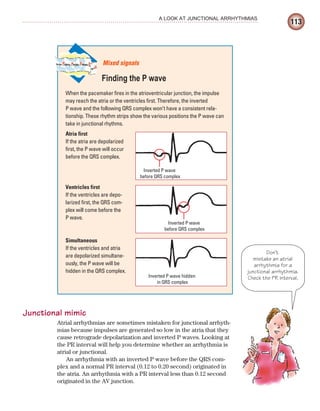113
A LOOK AT JUNCTIONAL ARRHYTHMIAS
Junctional mimic
Atrial arrhythmias are sometimes mistaken for junctional arrhyth-
mias because impulses are generated so low in the atria that they
cause retrograde depolarization and inverted P waves. Looking at
the PR interval will help you determine whether an arrhythmia is
atrial or junctional.
An arrhythmia with an inverted P wave before the QRS com-
plex and a normal PR interval (0.12 to 0.20 second) originated in
the atria. An arrhythmia with a PR interval less than 0.12 second
originated in the AV junction.
When the pacemaker fires in the atrioventricular junction, the impulse
may reach the atria or the ventricles first. Therefore, the inverted
P wave and the following QRS complex won’t have a consistent rela-
tionship. These rhythm strips show the various positions the P wave can
take in junctional rhythms.
Atria first
If the atria are depolarized
first, the P wave will occur
before the QRS complex.
Ventricles first
If the ventricles are depo-
larized first, the QRS com-
plex will come before the
P wave.
Simultaneous
If the ventricles and atria
are depolarized simultane-
ously, the P wave will be
hidden in the QRS complex.
Mixed signals
Finding the P wave
Inverted P wave
before QRS complex
Inverted P wave
before QRS complex
Inverted P wave hidden
in QRS complex
Don’t
mistake an atrial
arrhythmia for a
junctional arrhythmia.
Check the PR interval.
ECG_Chap06.indd 113
ECG_Chap06.indd 113 7/7/2010 5:56:57 PM
7/7/2010 5:56:57 PM
 