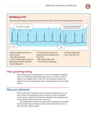 115
PREMATURE JUNCTIONAL CONTRACTION
Identifying a PJC
This rhythm strip illustrates premature junctional contraction (PJC). Look for these distinguishing characteristics.
That quickening feeling
The patient may be asymptomatic or he may complain of palpita-
tions or a feeling of quickening in the chest. You may be able to
palpate an irregular pulse. If the PJCs are frequent enough, the
patient may have hypotension from a transient decrease in cardiac
output.
How you intervene
PJCs usually don’t require treatment unless symptoms occur. In
those cases, the underlying cause should be treated. If digoxin
toxicity is the culprit, the medication should be discontinued and
serum digoxin (Lanoxin) levels monitored.
You should also monitor the patient for hemodynamic instabil-
ity. If ectopic beats are frequent, the patient should decrease or
eliminate his caffeine intake.
Rhythm:
• Irregular atrial and ven-
tricular rhythms
Rate:
• 100 beats/minute
P wave:
• Inverted and precedes the
QRS complex with PJC; otherwise
normal configuration
PR interval:
• 0.14 second for the
underlying rhythm and 0.06 second
for the PJC
QRS complex:
• 0.06 second
T wave:
• Normal configuration
QT interval:
• 0.36 second
Other:
• Pause after PJC
The rhythm is irregular. The P wave is inverted with PR
interval less than 0.12 second.
PJC
PJC
ECG_Chap06.indd 115
ECG_Chap06.indd 115 7/7/2010 5:56:59 PM
7/7/2010 5:56:59 PM
 