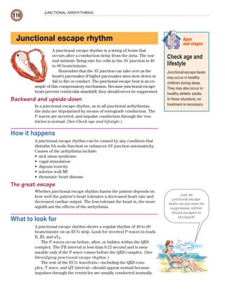 116
JUNCTIONAL ARRHYTHMIAS
Junctional escape rhythm
A junctional escape rhythm is a string of beats that
occurs after a conduction delay from the atria. The nor-
mal intrinsic firing rate for cells in the AV junction is 40
to 60 beats/minute.
Remember that the AV junction can take over as the
heart’s pacemaker if higher pacemaker sites slow down or
fail to fire or conduct. The junctional escape beat is an ex-
ample of this compensatory mechanism. Because junctional escape
beats prevent ventricular standstill, they should never be suppressed.
Backward and upside-down
In a junctional escape rhythm, as in all junctional arrhythmias,
the atria are depolarized by means of retrograde conduction. The
P waves are inverted, and impulse conduction through the ven-
tricles is normal. (See Check age and lifestyle.)
How it happens
A junctional escape rhythm can be caused by any condition that
disturbs SA node function or enhances AV junction automaticity.
Causes of the arrhythmia include:
sick sinus syndrome
•
vagal stimulation
•
digoxin toxicity
•
inferior wall MI
•
rheumatic heart disease.
•
The great escape
Whether junctional escape rhythm harms the patient depends on
how well the patient’s heart tolerates a decreased heart rate and
decreased cardiac output. The less tolerant the heart is, the more
significant the effects of the arrhythmia.
What to look for
A junctional escape rhythm shows a regular rhythm of 40 to 60
beats/minute on an ECG strip. Look for inverted P waves in leads
II, III, and aVF.
The P waves occur before, after, or hidden within the QRS
complex. The PR interval is less than 0.12 second and is mea-
surable only if the P wave comes before the QRS complex. (See
Identifying junctional escape rhythm.)
The rest of the ECG waveform—including the QRS com-
plex, T wave, and QT interval—should appear normal because
impulses through the ventricles are usually conducted normally.
Check age and
lifestyle
Junctional escape beats
may occur in healthy
children during sleep.
They may also occur in
healthy athletic adults.
In these situations, no
treatment is necessary.
Ages
and stages
Just as
junctional escape
beats should never be
suppressed, neither
should escapes to
the beach!
ECG_Chap06.indd 116
ECG_Chap06.indd 116 7/7/2010 5:56:59 PM
7/7/2010 5:56:59 PM
 