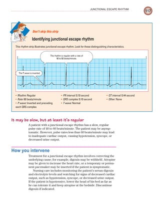 117
JUNCTIONAL ESCAPE RHYTHM
It may be slow, but at least it’s regular
A patient with a junctional escape rhythm has a slow, regular
pulse rate of 40 to 60 beats/minute. The patient may be asymp-
tomatic. However, pulse rates less than 60 beats/minute may lead
to inadequate cardiac output, causing hypotension, syncope, or
decreased urine output.
How you intervene
Treatment for a junctional escape rhythm involves correcting the
underlying cause; for example, digoxin may be withheld. Atropine
may be given to increase the heart rate, or a temporary or perma-
nent pacemaker may be inserted if the patient is symptomatic.
Nursing care includes monitoring the patient’s serum digoxin
and electrolyte levels and watching for signs of decreased cardiac
output, such as hypotension, syncope, or decreased urine output.
If the patient is hypotensive, lower the head of his bed as far as
he can tolerate it and keep atropine at the bedside. Discontinue
digoxin if indicated.
This rhythm strip illustrates junctional escape rhythm. Look for these distinguishing characteristics.
Don’t skip this strip
Identifying junctional escape rhythm
Rhythm:
• Regular
Rate:
• 60 beats/minute
P wave:
• Inverted and preceding
each QRS complex
PR interval:
• 0.10 second
QRS complex:
• 0.10 second
T wave:
• Normal
QT interval:
• 0.44 second
Other:
• None
The rhythm is regular with a rate of
40 to 60 beats/minute.
The P wave is inverted.
ECG_Chap06.indd 117
ECG_Chap06.indd 117 7/7/2010 5:57:01 PM
7/7/2010 5:57:01 PM
 
