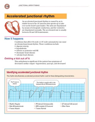 118
JUNCTIONAL ARRHYTHMIAS
Accelerated junctional rhythm
An accelerated junctional rhythm is caused by an ir-
ritable focus in the AV junction that speeds up to take
over as the heart’s pacemaker. The atria are depolarized
by means of retrograde conduction, and the ventricles
are depolarized normally. The accelerated rate is usually
between 60 and 100 beats/minute.
How it happens
Conditions that affect SA node or AV node automaticity can cause
accelerated junctional rhythm. These conditions include:
digoxin toxicity
•
hypokalemia
•
inferior or posterior wall MI
•
rheumatic heart disease
•
valvular heart disease.
•
Getting a kick out of it
This arrhythmia is significant if the patient has symptoms of
decreased cardiac output—hypotension, syncope, and decreased
Identifying accelerated junctional rhythm
This rhythm strip illustrates accelerated junctional rhythm. Look for these distinguishing characteristics.
The rhythm is regular with a rate
between 60 and 100 beats/minute.
The P wave is
absent.
Rhythm:
• Regular
Rate:
• 80 beats/minute
P wave:
• Absent
PR interval:
• Unmeasurable
QRS complex:
• 0.10 second
T wave:
• Normal
QT interval:
• 0.32 second
Other:
• None
ECG_Chap06.indd 118
ECG_Chap06.indd 118 7/7/2010 5:57:01 PM
7/7/2010 5:57:01 PM
 