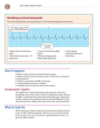 120
JUNCTIONAL ARRHYTHMIAS
How it happens
Possible causes of junctional tachycardia include:
digoxin toxicity (most common cause), which can be enhanced
•
by hypokalemia
inferior or posterior wall MI or ischemia
•
congenital heart disease in children
•
swelling of the AV junction after heart surgery.
•
Compromisin’ rhythm
The significance of junctional tachycardia depends on the rate,
underlying cause, and severity of the accompanying cardiac disease.
At higher ventricular rates, junctional tachycardia may compromise
cardiac output by decreasing the amount of blood filling the ventri-
cles with each beat. Higher rates also result in the loss of atrial kick.
What to look for
When assessing a rhythm strip for junctional tachycardia, look for
a rate of 100 to 200 beats/minute. The P wave is inverted in leads
II, III, and aVF and can occur before, during (hidden P wave), or
after the QRS complex.
Identifying junctional tachycardia
This rhythm strip illustrates junctional tachycardia. Look for these distinguishing characteristics.
The rhythm is regular with a
rate of 100 to 200 beats/minute.
The P wave is
inverted.
Rhythm:
• Atrial and ventricular—
regular
Rate:
• Atrial and ventricular—115
beats/minute
P wave:
• Inverted; follows QRS
complex
PR interval:
• Unmeasurable
QRS complex:
• 0.08 second
T wave:
• Normal
QT interval:
• 0.36 second
Other:
• None
ECG_Chap06.indd 120
ECG_Chap06.indd 120 7/7/2010 5:57:03 PM
7/7/2010 5:57:03 PM
 