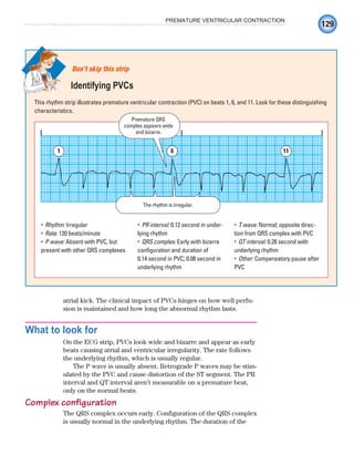 129
PREMATURE VENTRICULAR CONTRACTION
atrial kick. The clinical impact of PVCs hinges on how well perfu-
sion is maintained and how long the abnormal rhythm lasts.
What to look for
On the ECG strip, PVCs look wide and bizarre and appear as early
beats causing atrial and ventricular irregularity. The rate follows
the underlying rhythm, which is usually regular.
The P wave is usually absent. Retrograde P waves may be stim-
ulated by the PVC and cause distortion of the ST segment. The PR
interval and QT interval aren’t measurable on a premature beat,
only on the normal beats.
Complex configuration
The QRS complex occurs early. Configuration of the QRS complex
is usually normal in the underlying rhythm. The duration of the
This rhythm strip illustrates premature ventricular contraction (PVC) on beats 1, 6, and 11. Look for these distinguishing
characteristics.
Don’t skip this strip
Identifying PVCs
1 6 11
The rhythm is irregular.
Premature QRS
complex appears wide
and bizarre.
Rhythm:
• Irregular
Rate:
• 120 beats/minute
P wave:
• Absent with PVC, but
present with other QRS complexes
PR interval:
• 0.12 second in under-
lying rhythm
QRS complex:
• Early with bizarre
configuration and duration of
0.14 second in PVC; 0.08 second in
underlying rhythm
T wave:
• Normal; opposite direc-
tion from QRS complex with PVC
QT interval:
• 0.28 second with
underlying rhythm
Other:
• Compensatory pause after
PVC
ECG_Chap07.indd 129
ECG_Chap07.indd 129 7/7/2010 5:59:06 PM
7/7/2010 5:59:06 PM
 
