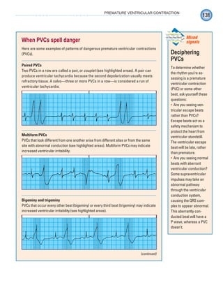 131
PREMATURE VENTRICULAR CONTRACTION
When PVCs spell danger
Here are some examples of patterns of dangerous premature ventricular contractions
(PVCs).
Paired PVCs
Two PVCs in a row are called a pair, or couplet (see highlighted areas). A pair can
produce ventricular tachycardia because the second depolarization usually meets
refractory tissue. A salvo—three or more PVCs in a row—is considered a run of
ventricular tachycardia.
Multiform PVCs
PVCs that look different from one another arise from different sites or from the same
site with abnormal conduction (see highlighted areas). Multiform PVCs may indicate
increased ventricular irritability.
Bigeminy and trigeminy
PVCs that occur every other beat (bigeminy) or every third beat (trigeminy) may indicate
increased ventricular irritability (see highlighted areas).
(continued)
Deciphering
PVCs
To determine whether
the rhythm you’re as-
sessing is a premature
ventricular contraction
(PVC) or some other
beat, ask yourself these
questions:
Are you seeing ven-
•
tricular escape beats
rather than PVCs?
Escape beats act as a
safety mechanism to
protect the heart from
ventricular standstill.
The ventricular escape
beat will be late, rather
than premature.
Are you seeing normal
•
beats with aberrant
ventricular conduction?
Some supraventricular
impulses may take an
abnormal pathway
through the ventricular
conduction system,
causing the QRS com-
plex to appear abnormal.
This aberrantly con-
ducted beat will have a
P wave, whereas a PVC
doesn’t.
Mixed
signals
ECG_Chap07.indd 131
ECG_Chap07.indd 131 7/7/2010 5:59:07 PM
7/7/2010 5:59:07 PM
 
