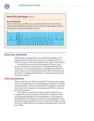 132
VENTRICULAR ARRHYTHMIAS
How you intervene
If the patient is asymptomatic, the arrhythmia probably won’t
require treatment. If he has symptoms or a dangerous form of
PVCs, the type of treatment depends on the cause of the problem.
The practitioner may order procainamide (Procan), amio-
darone (Cordarone), or lidocaine I.V. Potassium chloride may
be given I.V. to correct hypokalemia, and magnesium sulfate I.V.
may be given to correct hypomagnesemia. Other treatments may
be aimed at adjusting drug therapy or correcting acidosis, hypo-
thermia, or hypoxia.
Stat assessment
Patients who have recently developed PVCs need prompt assess-
ment, especially if they have underlying heart disease or complex
medical problems. Those with chronic PVCs should be observed
closely for the development of more frequent PVCs or more dan-
gerous PVC patterns.
Until effective treatment is begun, a patient with PVCs ac-
companied by serious symptoms should have continuous ECG
monitoring and ambulate only with assistance. If the patient is
discharged from the health care facility on antiarrhythmic drugs,
family members should know how to contact the emergency medi-
cal service (EMS) and how to perform cardiopulmonary resuscita-
tion (CPR).
When PVCs spell danger (continued)
R-on-T phenomenon
In R-on-T phenomenon, the PVC occurs so early that it falls on the T wave of the pre-
ceding beat (see highlighted area). Because the cells haven’t fully repolarized, ventricu-
lar tachycardia or ventricular fibrillation can result.
ECG_Chap07.indd 132
ECG_Chap07.indd 132 7/7/2010 5:59:08 PM
7/7/2010 5:59:08 PM
 