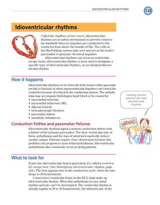 133
IDIOVENTRICULAR RHYTHMS
Idioventricular rhythms
Called the rhythms of last resort, idioventricular
rhythms act as safety mechanisms to prevent ventricu-
lar standstill when no impulses are conducted to the
ventricles from above the bundle of His. The cells of
the His-Purkinje system take over and act as the heart’s
pacemaker to generate electrical impulses.
Idioventricular rhythms can occur as ventricular
escape beats, idioventricular rhythm (a term used to designate a
specific type of idioventricular rhythm), or accelerated idioven-
tricular rhythm.
How it happens
Idioventricular rhythms occur when all of the heart’s other pacemak-
ers fail to function or when supraventricular impulses can’t reach the
ventricles because of a block in the conduction system. The arrhyth-
mias may accompany third-degree heart block or be caused by:
myocardial ischemia
•
myocardial infarction (MI)
•
digoxin toxicity
•
beta-adrenergic blockers
•
pacemaker failure
•
metabolic imbalances.
•
Conduction foibles and pacemaker failures
Idioventricular rhythms signal a serious conduction defect with
a failure of the primary pacemaker. The slow ventricular rate of
these arrhythmias and the loss of atrial kick markedly reduce
cardiac output. Patients require close observation because this
problem can progress to more lethal arrhythmias. Idioventricular
arrhythmias also commonly occur in dying patients.
What to look for
If just one idioventricular beat is generated, it’s called a ventricu-
lar escape beat. (See Identifying idioventricular rhythm, page
134.) The beat appears late in the conduction cycle, when the rate
drops to 40 beats/minute.
Consecutive ventricular beats on the ECG strip make up
idioventricular rhythm. When this arrhythmia occurs, atrial
rhythm and rate can’t be determined. The ventricular rhythm is
usually regular at 20 to 40 beats/minute, the inherent rate of the
Carefully monitor
patients who have
idioventricular
rhythms.
ECG_Chap07.indd 133
ECG_Chap07.indd 133 7/7/2010 5:59:08 PM
7/7/2010 5:59:08 PM
 