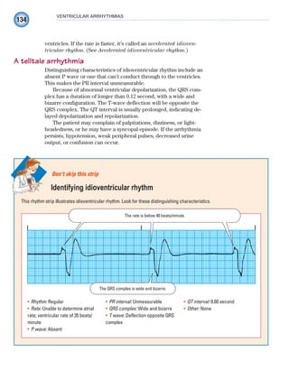 134
VENTRICULAR ARRHYTHMIAS
ventricles. If the rate is faster, it’s called an accelerated idioven-
tricular rhythm. (See Accelerated idioventricular rhythm.)
A telltale arrhythmia
Distinguishing characteristics of idioventricular rhythm include an
absent P wave or one that can’t conduct through to the ventricles.
This makes the PR interval unmeasurable.
Because of abnormal ventricular depolarization, the QRS com-
plex has a duration of longer than 0.12 second, with a wide and
bizarre configuration. The T-wave deflection will be opposite the
QRS complex. The QT interval is usually prolonged, indicating de-
layed depolarization and repolarization.
The patient may complain of palpitations, dizziness, or light-
headedness, or he may have a syncopal episode. If the arrhythmia
persists, hypotension, weak peripheral pulses, decreased urine
output, or confusion can occur.
This rhythm strip illustrates idioventricular rhythm. Look for these distinguishing characteristics.
Don’t skip this strip
Identifying idioventricular rhythm
The rate is below 40 beats/minute.
The QRS complex is wide and bizarre.
Rhythm:
• Regular
Rate:
• Unable to determine atrial
rate; ventricular rate of 35 beats/
minute
P wave:
• Absent
PR interval:
• Unmeasurable
QRS complex:
• Wide and bizarre
T wave:
• Deflection opposite QRS
complex
QT interval:
• 0.60 second
Other:
• None
ECG_Chap07.indd 134
ECG_Chap07.indd 134 7/7/2010 5:59:10 PM
7/7/2010 5:59:10 PM
 