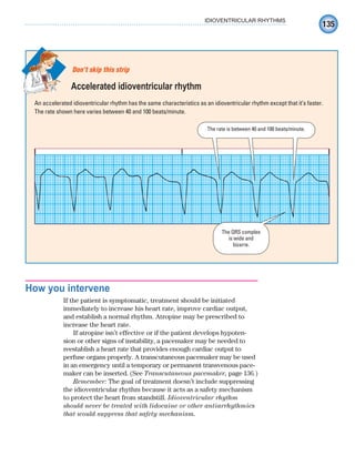 135
IDIOVENTRICULAR RHYTHMS
How you intervene
If the patient is symptomatic, treatment should be initiated
immediately to increase his heart rate, improve cardiac output,
and establish a normal rhythm. Atropine may be prescribed to
increase the heart rate.
If atropine isn’t effective or if the patient develops hypoten-
sion or other signs of instability, a pacemaker may be needed to
reestablish a heart rate that provides enough cardiac output to
perfuse organs properly. A transcutaneous pacemaker may be used
in an emergency until a temporary or permanent transvenous pace-
maker can be inserted. (See Transcutaneous pacemaker, page 136.)
Remember: The goal of treatment doesn’t include suppressing
the idioventricular rhythm because it acts as a safety mechanism
to protect the heart from standstill. Idioventricular rhythm
should never be treated with lidocaine or other antiarrhythmics
that would suppress that safety mechanism.
An accelerated idioventricular rhythm has the same characteristics as an idioventricular rhythm except that it’s faster.
The rate shown here varies between 40 and 100 beats/minute.
Don’t skip this strip
Accelerated idioventricular rhythm
The rate is between 40 and 100 beats/minute.
The QRS complex
is wide and
bizarre.
ECG_Chap07.indd 135
ECG_Chap07.indd 135 7/7/2010 5:59:11 PM
7/7/2010 5:59:11 PM
 