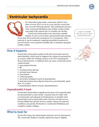 137
VENTRICULAR TACHYCARDIA
Ventricular tachycardia
In ventricular tachycardia, commonly called V-tach,
three or more PVCs occur in a row and the ventricular
rate exceeds 100 beats/minute. This arrhythmia may pre-
cede ventricular fibrillation and sudden cardiac death,
especially if the patient isn’t in a health care facility.
Ventricular tachycardia is an extremely unstable
rhythm. It can occur in short, paroxysmal bursts lasting
fewer than 30 seconds and causing few or no symptoms. Alter-
natively, it can be sustained, requiring immediate treatment to
prevent death, even in patients initially able to maintain adequate
cardiac output.
How it happens
Ventricular tachycardia usually results from increased myocar-
dial irritability, which may be triggered by enhanced automaticity
or reentry within the Purkinje system or by PVCs initiating the
R-on-T phenomenon. Conditions that can cause ventricular tachy-
cardia include:
myocardial ischemia
•
MI
•
coronary artery disease
•
valvular heart disease
•
heart failure
•
cardiomyopathy
•
electrolyte imbalances such as hypokalemia
•
drug intoxication from digoxin (Lanoxin), procainamide, quini-
•
dine, or cocaine
proarrhythmic effects of some antiarrhythmics.
•
Unpredictable V-tach
Ventricular tachycardia is significant because of its unpredictabil-
ity and potential to cause death. A patient may be stable with
a normal pulse and adequate hemodynamics or unstable with
hypotension and no detectable pulse. Because of reduced ven-
tricular filling time and the drop in cardiac output, the patient’s
condition can quickly deteriorate to ventricular fibrillation and
complete cardiac collapse.
What to look for
On the ECG strip, the atrial rhythm and rate can’t be determined.
The ventricular rhythm is usually regular but may be slightly
V-tach is unstable
and can occur in short
paroxysmal bursts.
ECG_Chap07.indd 137
ECG_Chap07.indd 137 7/7/2010 5:59:12 PM
7/7/2010 5:59:12 PM
 