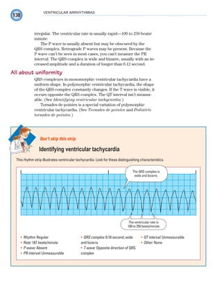 138
VENTRICULAR ARRHYTHMIAS
irregular. The ventricular rate is usually rapid—100 to 250 beats/
minute.
The P wave is usually absent but may be obscured by the
QRS complex. Retrograde P waves may be present. Because the
P wave can’t be seen in most cases, you can’t measure the PR
interval. The QRS complex is wide and bizarre, usually with an in-
creased amplitude and a duration of longer than 0.12 second.
All about uniformity
QRS complexes in monomorphic ventricular tachycardia have a
uniform shape. In polymorphic ventricular tachycardia, the shape
of the QRS complex constantly changes. If the T wave is visible, it
occurs opposite the QRS complex. The QT interval isn’t measur-
able. (See Identifying ventricular tachycardia.)
Torsades de pointes is a special variation of polymorphic
ventricular tachycardia. (See Torsades de pointes and Pediatric
torsades de pointes.)
This rhythm strip illustrates ventricular tachycardia. Look for these distinguishing characteristics.
Don’t skip this strip
Identifying ventricular tachycardia
The QRS complex is
wide and bizarre.
The ventricular rate is
100 to 250 beats/minute.
Rhythm:
• Regular
Rate:
• 187 beats/minute
P wave:
• Absent
PR interval:
• Unmeasurable
QRS complex:
• 0.16 second; wide
and bizarre
T wave:
• Opposite direction of QRS
complex
QT interval:
• Unmeasurable
Other:
• None
ECG_Chap07.indd 138
ECG_Chap07.indd 138 7/7/2010 5:59:13 PM
7/7/2010 5:59:13 PM
 