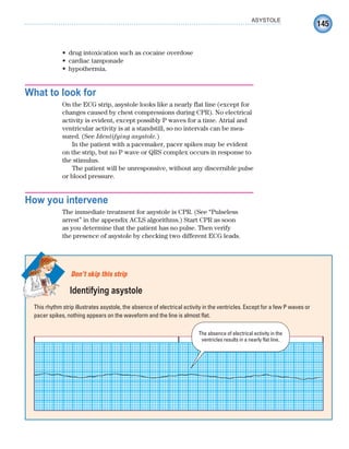 145
ASYSTOLE
drug intoxication such as cocaine overdose
•
cardiac tamponade
•
hypothermia.
•
What to look for
On the ECG strip, asystole looks like a nearly flat line (except for
changes caused by chest compressions during CPR). No electrical
activity is evident, except possibly P waves for a time. Atrial and
ventricular activity is at a standstill, so no intervals can be mea-
sured. (See Identifying asystole.)
In the patient with a pacemaker, pacer spikes may be evident
on the strip, but no P wave or QRS complex occurs in response to
the stimulus.
The patient will be unresponsive, without any discernible pulse
or blood pressure.
How you intervene
The immediate treatment for asystole is CPR. (See “Pulseless
arrest” in the appendix ACLS algorithms.) Start CPR as soon
as you determine that the patient has no pulse. Then verify
the presence of asystole by checking two different ECG leads.
This rhythm strip illustrates asystole, the absence of electrical activity in the ventricles. Except for a few P waves or
pacer spikes, nothing appears on the waveform and the line is almost flat.
Don’t skip this strip
Identifying asystole
The absence of electrical activity in the
ventricles results in a nearly flat line.
ECG_Chap07.indd 145
ECG_Chap07.indd 145 7/7/2010 5:59:18 PM
7/7/2010 5:59:18 PM
 