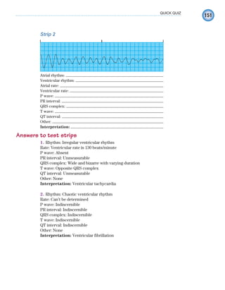 151
QUICK QUIZ
Strip 2
Atrial rhythm:
Ventricular rhythm:
Atrial rate:
Ventricular rate:
P wave:
PR interval:
QRS complex:
T wave:
QT interval:
Other:
Interpretation:
Answers to test strips
1. Rhythm: Irregular ventricular rhythm
Rate: Ventricular rate is 130 beats/minute
P wave: Absent
PR interval: Unmeasurable
QRS complex: Wide and bizarre with varying duration
T wave: Opposite QRS complex
QT interval: Unmeasurable
Other: None
Interpretation: Ventricular tachycardia
2. Rhythm: Chaotic ventricular rhythm
Rate: Can’t be determined
P wave: Indiscernible
PR interval: Indiscernible
QRS complex: Indiscernible
T wave: Indiscernible
QT interval: Indiscernible
Other: None
Interpretation: Ventricular fibrillation
ECG_Chap07.indd 151
ECG_Chap07.indd 151 7/7/2010 5:59:20 PM
7/7/2010 5:59:20 PM
 