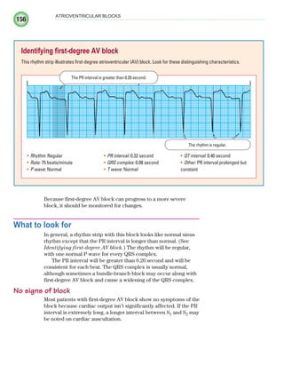 156
ATRIOVENTRICULAR BLOCKS
Because first-degree AV block can progress to a more severe
block, it should be monitored for changes.
What to look for
In general, a rhythm strip with this block looks like normal sinus
rhythm except that the PR interval is longer than normal. (See
Identifying first-degree AV block.) The rhythm will be regular,
with one normal P wave for every QRS complex.
The PR interval will be greater than 0.20 second and will be
consistent for each beat. The QRS complex is usually normal,
although sometimes a bundle-branch block may occur along with
first-degree AV block and cause a widening of the QRS complex.
No signs of block
Most patients with first-degree AV block show no symptoms of the
block because cardiac output isn’t significantly affected. If the PR
interval is extremely long, a longer interval between S1 and S2 may
be noted on cardiac auscultation.
Identifying first-degree AV block
This rhythm strip illustrates first-degree atrioventricular (AV) block. Look for these distinguishing characteristics.
Rhythm:
• Regular
Rate:
• 75 beats/minute
P wave:
• Normal
PR interval:
• 0.32 second
QRS complex:
• 0.08 second
T wave:
• Normal
QT interval:
• 0.40 second
Other:
• PR interval prolonged but
constant
The PR interval is greater than 0.20 second.
The rhythm is regular.
ECG_Chap08.indd 156
ECG_Chap08.indd 156 7/8/2010 4:27:52 PM
7/8/2010 4:27:52 PM
 