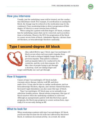 157
TYPE I SECOND-DEGREE AV BLOCK
How you intervene
Usually, just the underlying cause will be treated, not the conduc-
tion disturbance itself. For example, if a medication is causing the
block, the dosage may be reduced or the medication may be dis-
continued. Close monitoring helps to detect progression of first-
degree AV block to a more serious form of block.
When caring for a patient with first-degree AV block, evaluate
him for underlying causes that can be corrected, such as medica-
tions or ischemia. Observe the ECG for progression of the block
to a more severe form of block. Administer digoxin, calcium chan-
nel blockers, or beta-adrenergic blockers cautiously.
Type I second-degree AV block
Also called Mobitz type I block, type I second-degree AV
block occurs when each successive impulse from
the SA node is delayed slightly longer than the
previous impulse. That pattern continues
until an impulse fails to be conducted to the
ventricles, and the cycle then repeats. It’s
like a line of people trying to get through
a doorway, each one taking longer and
longer until finally one can’t get through.
How it happens
Causes of type I second-degree AV block include
coronary artery disease, inferior wall MI, and rheu-
matic fever. It may also be due to cardiac medications, such as
beta-adrenergic blockers, digoxin, and calcium channel blockers.
Increased vagal stimulation can also cause this type of block.
Type I second-degree AV block may occur normally in an
otherwise healthy person. Almost always temporary, this type of
block resolves when the underlying condition is corrected.
Although an asymptomatic patient with this block has a good
prognosis, the block may progress to a more serious form, espe-
cially if it occurs early during an MI.
What to look for
When monitoring a patient with type I second-degree AV block,
you’ll note that because the SA node isn’t affected by this lower
block, it continues its normal activity. As a result, the atrial
ECG_Chap08.indd 157
ECG_Chap08.indd 157 7/8/2010 4:27:52 PM
7/8/2010 4:27:52 PM
 