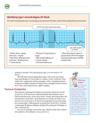 158
ATRIOVENTRICULAR BLOCKS
rhythm is normal. (See Identifying type I second-degree AV
block.)
The PR interval gets gradually longer with each successive
beat until finally a P wave fails to conduct to the ventricles. This
makes the ventricular rhythm irregular, with a repeating pattern
of groups of QRS complexes followed by a dropped beat in which
the P wave isn’t followed by a QRS complex.
Famous footprints
That pattern of grouped beating is sometimes referred to as the
footprints of Wenckebach. (Karel Frederik Wenckebach was a
Dutch internist who, at the turn of the century and long before the
introduction of the ECG, described the two forms of what’s now
known as second-degree AV block by analyzing waves in the jugu-
lar venous pulse. Following the introduction of the ECG, German
cardiologist Woldemar Mobitz clarified Wenckebach’s findings as
type I and type II.)
As you’ve probably noticed by now, rhythm strips have distinc-
tive patterns. (See Rhythm strip patterns.)
Identifying type I second-degree AV block
This rhythm strip illustrates type I second-degree atrioventricular (AV) block. Look for these distinguishing characteristics.
The PR interval gets progressively longer…
…until a QRS complex
is dropped.
Rhythm:
• Atrial—regular;
ventricular—irregular
Rate:
• Atrial—80 beats/minute;
ventricular—50 beats/minute
P wave:
• Normal
PR interval:
• Progressively pro-
longed
QRS complex:
• 0.08 second
T wave:
• Inverted
QT interval:
• 0.46 second
Other:
• Wenckebach pattern of
grouped beats; PR interval appear-
ing progressively longer until QRS
complex drops
Memory
jogger
To help you
identify
type I second-degree
AV block, think of
the phrase “longer,
longer, drop,” which
describes the pro-
gressively prolonged
PR intervals and the
missing QRS complex.
(The QRS complexes,
by the way, are usu-
ally normal because
the delays occur in
the AV node.)
ECG_Chap08.indd 158
ECG_Chap08.indd 158 7/8/2010 4:27:53 PM
7/8/2010 4:27:53 PM
 