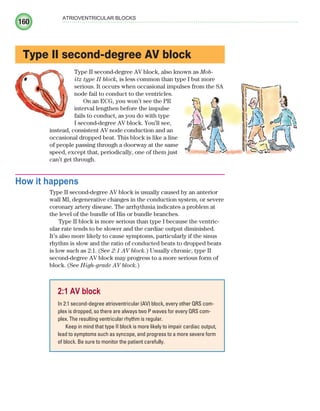 160
ATRIOVENTRICULAR BLOCKS
Type II second-degree AV block
Type II second-degree AV block, also known as Mob-
itz type II block, is less common than type I but more
serious. It occurs when occasional impulses from the SA
node fail to conduct to the ventricles.
On an ECG, you won’t see the PR
interval lengthen before the impulse
fails to conduct, as you do with type
I second-degree AV block. You’ll see,
instead, consistent AV node conduction and an
occasional dropped beat. This block is like a line
of people passing through a doorway at the same
speed, except that, periodically, one of them just
can’t get through.
How it happens
Type II second-degree AV block is usually caused by an anterior
wall MI, degenerative changes in the conduction system, or severe
coronary artery disease. The arrhythmia indicates a problem at
the level of the bundle of His or bundle branches.
Type II block is more serious than type I because the ventric-
ular rate tends to be slower and the cardiac output diminished.
It’s also more likely to cause symptoms, particularly if the sinus
rhythm is slow and the ratio of conducted beats to dropped beats
is low such as 2:1. (See 2:1 AV block.) Usually chronic, type II
second-degree AV block may progress to a more serious form of
block. (See High-grade AV block.)
2:1 AV block
In 2:1 second-degree atrioventricular (AV) block, every other QRS com-
plex is dropped, so there are always two P waves for every QRS com-
plex. The resulting ventricular rhythm is regular.
Keep in mind that type II block is more likely to impair cardiac output,
lead to symptoms such as syncope, and progress to a more severe form
of block. Be sure to monitor the patient carefully.
ECG_Chap08.indd 160
ECG_Chap08.indd 160 7/8/2010 4:27:55 PM
7/8/2010 4:27:55 PM
 