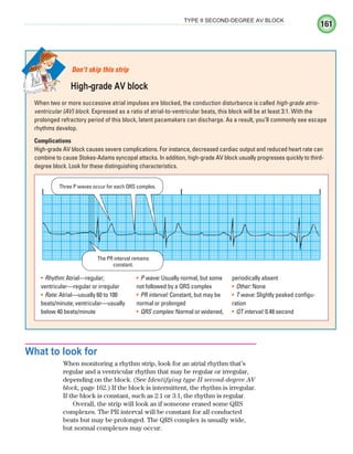 161
TYPE II SECOND-DEGREE AV BLOCK
What to look for
When monitoring a rhythm strip, look for an atrial rhythm that’s
regular and a ventricular rhythm that may be regular or irregular,
depending on the block. (See Identifying type II second-degree AV
block, page 162.) If the block is intermittent, the rhythm is irregular.
If the block is constant, such as 2:1 or 3:1, the rhythm is regular.
Overall, the strip will look as if someone erased some QRS
complexes. The PR interval will be constant for all conducted
beats but may be prolonged. The QRS complex is usually wide,
but normal complexes may occur.
When two or more successive atrial impulses are blocked, the conduction disturbance is called high-grade atrio-
ventricular (AV) block. Expressed as a ratio of atrial-to-ventricular beats, this block will be at least 3:1. With the
prolonged refractory period of this block, latent pacemakers can discharge. As a result, you’ll commonly see escape
rhythms develop.
Complications
High-grade AV block causes severe complications. For instance, decreased cardiac output and reduced heart rate can
combine to cause Stokes-Adams syncopal attacks. In addition, high-grade AV block usually progresses quickly to third-
degree block. Look for these distinguishing characteristics.
Don’t skip this strip
High-grade AV block
Three P waves occur for each QRS complex.
The PR interval remains
constant.
Rhythm:
• Atrial—regular;
ventricular—regular or irregular
Rate:
• Atrial—usually 60 to 100
beats/minute; ventricular—usually
below 40 beats/minute
P wave:
• Usually normal, but some
not followed by a QRS complex
PR interval:
• Constant, but may be
normal or prolonged
QRS complex:
• Normal or widened,
periodically absent
Other:
• None
T wave:
• Slightly peaked configu-
ration
QT interval:
• 0.48 second
ECG_Chap08.indd 161
ECG_Chap08.indd 161 7/8/2010 4:27:56 PM
7/8/2010 4:27:56 PM
 