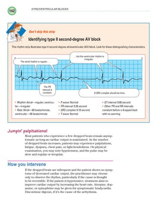 162
ATRIOVENTRICULAR BLOCKS
Jumpin’ palpitations!
Most patients who experience a few dropped beats remain asymp-
tomatic as long as cardiac output is maintained. As the number
of dropped beats increases, patients may experience palpitations,
fatigue, dyspnea, chest pain, or light-headedness. On physical
examination, you may note hypotension, and the pulse may be
slow and regular or irregular.
How you intervene
If the dropped beats are infrequent and the patient shows no symp-
toms of decreased cardiac output, the practitioner may choose
only to observe the rhythm, particularly if the cause is thought
to be reversible. If the patient is hypotensive, treatment aims to
improve cardiac output by increasing the heart rate. Atropine, dop-
amine, or epinephrine may be given for symptomatic bradycardia.
Discontinue digoxin, if it’s the cause of the arrhythmia.
This rhythm strip illustrates type II second-degree atrioventricular (AV) block. Look for these distinguishing characteristics.
Don’t skip this strip
Identifying type II second-degree AV block
…but the ventricular rhythm is
irregular.
The atrial rhythm is regular…
The PR
interval is
constant. A QRS complex should be here.
Rhythm:
• Atrial—regular; ventricu-
lar—irregular
Rate:
• Atrial—60 beats/minute;
ventricular—50 beats/minute
P wave:
• Normal
PR interval:
• 0.28 second
QRS complex:
• 0.10 second
T wave:
• Normal
QT interval:
• 0.60 second
Other:
• PR and RR intervals
constant before a dropped beat
with no warning
ECG_Chap08.indd 162
ECG_Chap08.indd 162 7/8/2010 4:27:57 PM
7/8/2010 4:27:57 PM
 