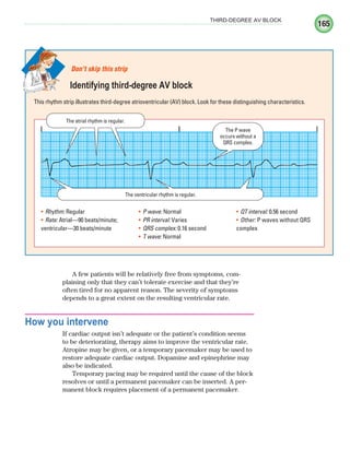 165
THIRD-DEGREE AV BLOCK
A few patients will be relatively free from symptoms, com-
plaining only that they can’t tolerate exercise and that they’re
often tired for no apparent reason. The severity of symptoms
depends to a great extent on the resulting ventricular rate.
How you intervene
If cardiac output isn’t adequate or the patient’s condition seems
to be deteriorating, therapy aims to improve the ventricular rate.
Atropine may be given, or a temporary pacemaker may be used to
restore adequate cardiac output. Dopamine and epinephrine may
also be indicated.
Temporary pacing may be required until the cause of the block
resolves or until a permanent pacemaker can be inserted. A per-
manent block requires placement of a permanent pacemaker.
This rhythm strip illustrates third-degree atrioventricular (AV) block. Look for these distinguishing characteristics.
Don’t skip this strip
Identifying third-degree AV block
The atrial rhythm is regular.
The P wave
occurs without a
QRS complex.
The ventricular rhythm is regular.
Rhythm:
• Regular
Rate:
• Atrial—90 beats/minute;
ventricular—30 beats/minute
P wave:
• Normal
PR interval:
• Varies
QRS complex:
• 0.16 second
T wave:
• Normal
QT interval:
• 0.56 second
Other:
• P waves without QRS
complex
ECG_Chap08.indd 165
ECG_Chap08.indd 165 7/8/2010 4:27:59 PM
7/8/2010 4:27:59 PM
 