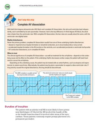 166
ATRIOVENTRICULAR BLOCKS
Bundles of troubles
The patient with an anterior wall MI is more likely to have perma-
nent third-degree AV block if the MI involved the bundle of His
or the bundle branches than if it involved other areas of the myo-
cardium. Those patients commonly require prompt placement of a
permanent pacemaker.
With both third-degree atrioventricular (AV) block and complete AV dissociation, the atria and ventricles beat indepen-
dently, each controlled by its own pacemaker. However, here’s the key difference: In third-degree AV block, the atrial
rate is faster than the ventricular rate. With complete AV dissociation, the two rates are usually about the same, with the
ventricular rate slightly faster.
Rhythm disturbances
Never the primary problem, complete AV dissociation results from one of three underlying rhythm disturbances:
slowed or impaired sinus impulse formation or sinoatrial conduction, as in sinus bradycardia or sinus arrest
•
accelerated impulse formation in the AV junction or the ventricle, as in accelerated junctional or ventricular tachycardia
•
AV conduction disturbance, as in complete AV block.
•
When to treat
The clinical significance of complete AV dissociation—as well as treatment for the arrhythmia—depends on the under-
lying cause and its effect on the patient. If the underlying rhythm decreases cardiac output, the patient will need treat-
ment to correct the arrhythmia.
Depending on the underlying cause, the patient may be treated with an antiarrhythmic, such as atropine and isopro-
terenol, to restore synchrony. Alternatively, the patient may be given a pacemaker to support a slow ventricular rate. If
drug toxicity caused the original disturbance, the drug should be discontinued.
Don’t skip this strip
Complete AV dissociation
The atrial and ventricular rates are nearly equal,
and the rhythms are regular.
The P wave isn’t related
to the QRS complex.
The QRS complex is usually normal
but may be wide and bizarre.
ECG_Chap08.indd 166
ECG_Chap08.indd 166 7/8/2010 4:28:00 PM
7/8/2010 4:28:00 PM
 