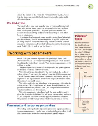 177
WORKING WITH PACEMAKERS
either the atrium or the ventricle. For dual-chamber, or AV, pac-
ing, the leads are placed in both chambers, usually on the right
side of the heart.
One lead or two
The electrodes—one on a unipolar lead or two on a bipolar lead—
send information about electrical impulses in the myocardium
back to the pulse generator. The pulse generator senses the
heart’s electrical activity and responds according to how it has
been programmed.
A unipolar lead system is more sensitive to the heart’s intrinsic
electrical activity than is a bipolar system. A bipolar system isn’t
as easily affected by electrical activity outside the heart and the
generator (for example, from skeletal muscle contraction or mag-
netic fields). (See A look at pacing leads.)
Working with pacemakers
On an ECG, you’ll notice a pacemaker spike right away. (See
Pacemaker spikes.) It occurs when the pacemaker sends an elec-
trical impulse to the heart muscle. That impulse appears as a verti-
cal line or spike.
Depending on the position of the electrode, the spike appears
in different locations on the waveform.
When the atria are stimulated by the pacemaker, the spike is
•
followed by a P wave and the patient’s baseline QRS complex and
T wave. This series of waveforms represents successful pacing, or
capture, of the myocardium. The P wave may look different from
the patient’s normal P wave.
When the ventricles are stimulated by a pacemaker, the spike is
•
followed by a QRS complex and a T wave. The QRS complex ap-
pears wider than the patient’s own QRS complex because of the
way the ventricles are depolarized.
When the pacemaker stimulates both the atria and the ventri-
•
cles, the first spike is followed by a P wave, then a spike, and then
a QRS complex. Be aware that the type of pacemaker used and
the patient’s condition may affect whether every beat is paced.
Permanent and temporary pacemakers
Depending on the patient’s signs and symptoms, a permanent or a
temporary pacemaker can be used to maintain heart rhythm. Lead
placement varies according to the patient’s specific needs.
Pacemaker
spikes
Pacemaker impulses—
the stimuli that travel
from the pacemaker to
the heart—are visible on
the patient’s ECG trac-
ing as spikes. Large or
small, pacemaker spikes
appear above or below
the isoelectric line. This
example shows an atrial
and a ventricular pace-
maker spike.
P wave
Atrial
pacemaker
spike
Ventricular
pacemaker
spike
QRS complex
ECG_Chap09.indd 177
ECG_Chap09.indd 177 7/8/2010 4:31:01 PM
7/8/2010 4:31:01 PM
 