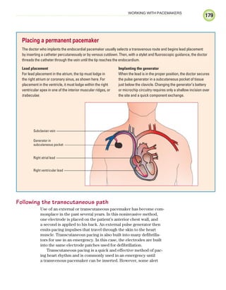 179
WORKING WITH PACEMAKERS
Following the transcutaneous path
Use of an external or transcutaneous pacemaker has become com-
monplace in the past several years. In this noninvasive method,
one electrode is placed on the patient’s anterior chest wall, and
a second is applied to his back. An external pulse generator then
emits pacing impulses that travel through the skin to the heart
muscle. Transcutaneous pacing is also built into many defibrilla-
tors for use in an emergency. In this case, the electrodes are built
into the same electrode patches used for defibrillation.
Transcutaneous pacing is a quick and effective method of pac-
ing heart rhythm and is commonly used in an emergency until
a transvenous pacemaker can be inserted. However, some alert
Placing a permanent pacemaker
The doctor who implants the endocardial pacemaker usually selects a transvenous route and begins lead placement
by inserting a catheter percutaneously or by venous cutdown. Then, with a stylet and fluoroscopic guidance, the doctor
threads the catheter through the vein until the tip reaches the endocardium.
Lead placement
For lead placement in the atrium, the tip must lodge in
the right atrium or coronary sinus, as shown here. For
placement in the ventricle, it must lodge within the right
ventricular apex in one of the interior muscular ridges, or
trabeculae.
Implanting the generator
When the lead is in the proper position, the doctor secures
the pulse generator in a subcutaneous pocket of tissue
just below the clavicle. Changing the generator’s battery
or microchip circuitry requires only a shallow incision over
the site and a quick component exchange.
Subclavian vein
Right ventricular lead
Right atrial lead
Generator in
subcutaneous pocket
ECG_Chap09.indd 179
ECG_Chap09.indd 179 7/8/2010 4:31:02 PM
7/8/2010 4:31:02 PM
 