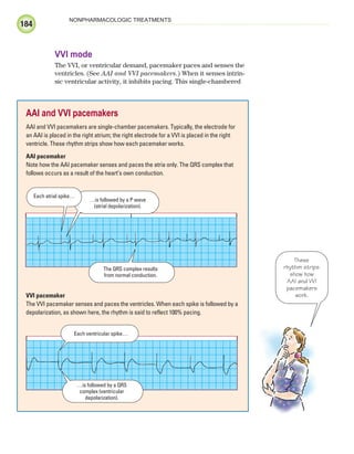 184
NONPHARMACOLOGIC TREATMENTS
VVI mode
The VVI, or ventricular demand, pacemaker paces and senses the
ventricles. (See AAI and VVI pacemakers.) When it senses intrin-
sic ventricular activity, it inhibits pacing. This single-chambered
AAI and VVI pacemakers
AAI and VVI pacemakers are single-chamber pacemakers. Typically, the electrode for
an AAI is placed in the right atrium; the right electrode for a VVI is placed in the right
ventricle. These rhythm strips show how each pacemaker works.
AAI pacemaker
Note how the AAI pacemaker senses and paces the atria only. The QRS complex that
follows occurs as a result of the heart’s own conduction.
VVI pacemaker
The VVI pacemaker senses and paces the ventricles. When each spike is followed by a
depolarization, as shown here, the rhythm is said to reflect 100% pacing.
Each ventricular spike…
…is followed by a QRS
complex (ventricular
depolarization).
These
rhythm strips
show how
AAI and VVI
pacemakers
work.
…is followed by a P wave
(atrial depolarization).
Each atrial spike…
The QRS complex results
from normal conduction.
ECG_Chap09.indd 184
ECG_Chap09.indd 184 7/8/2010 4:31:06 PM
7/8/2010 4:31:06 PM
 