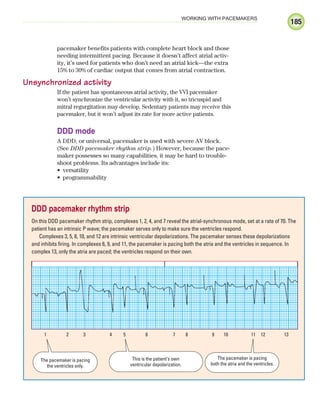 185
WORKING WITH PACEMAKERS
pacemaker benefits patients with complete heart block and those
needing intermittent pacing. Because it doesn’t affect atrial activ-
ity, it’s used for patients who don’t need an atrial kick—the extra
15% to 30% of cardiac output that comes from atrial contraction.
Unsynchronized activity
If the patient has spontaneous atrial activity, the VVI pacemaker
won’t synchronize the ventricular activity with it, so tricuspid and
mitral regurgitation may develop. Sedentary patients may receive this
pacemaker, but it won’t adjust its rate for more active patients.
DDD mode
A DDD, or universal, pacemaker is used with severe AV block.
(See DDD pacemaker rhythm strip.) However, because the pace-
maker possesses so many capabilities, it may be hard to trouble-
shoot problems. Its advantages include its:
versatility
•
programmability
•
DDD pacemaker rhythm strip
On this DDD pacemaker rhythm strip, complexes 1, 2, 4, and 7 reveal the atrial-synchronous mode, set at a rate of 70. The
patient has an intrinsic P wave; the pacemaker serves only to make sure the ventricles respond.
Complexes 3, 5, 8, 10, and 12 are intrinsic ventricular depolarizations. The pacemaker senses these depolarizations
and inhibits firing. In complexes 6, 9, and 11, the pacemaker is pacing both the atria and the ventricles in sequence. In
complex 13, only the atria are paced; the ventricles respond on their own.
1 2 3 4 5 6 7 8 9 10 11 12 13
The pacemaker is pacing
the ventricles only.
This is the patient’s own
ventricular depolarization.
The pacemaker is pacing
both the atria and the ventricles.
ECG_Chap09.indd 185
ECG_Chap09.indd 185 7/8/2010 4:31:07 PM
7/8/2010 4:31:07 PM
 