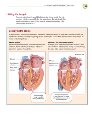 195
A LOOK AT RADIOFREQUENCY ABLATION
Hitting the target
In most patients with atrial fibrillation, the tissue inside the pul-
monary vein is responsible for the arrhythmia. Targeted radiofre-
quency ablation is used to block these abnormal impulses. (See
Destroying the source.)
Destroying the source
In radiofrequency ablation, special catheters are inserted in a vein and advanced to the heart. After the source of the
arrhythmia is identified, radiofrequency energy is used to destroy the source of the abnormal electrical impulses or ab-
normal conduction pathway.
SA node
Radiofrequency
catheter
Right atrium
AV node
SA node
Radiofrequency
catheter
Pulmonary vein
AV node ablation
If a rapid arrhythmia originates above the atrioventricular
(AV) node, the AV node may be destroyed to block im-
pulses from reaching the ventricles.
Pulmonary vein isolation and ablation
If ectopic foci in the pulmonary vein are the source of the
atrial fibrillation, radiofrequency energy is used to destroy
the tissue at the base of the pulmonary vein.
Radiofrequency energy
is used to destroy the tissue
where the atrium connects to
the pulmonary vein.
Radiofrequency
energy is used to
destroy the AV node.
ECG_Chap09.indd 195
ECG_Chap09.indd 195 7/8/2010 4:31:13 PM
7/8/2010 4:31:13 PM
 