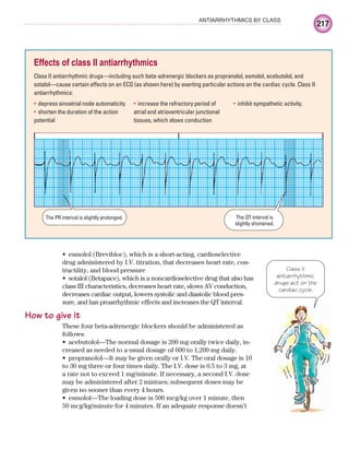 217
ANTIARRHYTHMICS BY CLASS
esmolol (Brevibloc), which is a short-acting, cardioselective
•
drug administered by I.V. titration, that decreases heart rate, con-
tractility, and blood pressure
sotalol (Betapace), which is a noncardioselective drug that also has
•
class III characteristics, decreases heart rate, slows AV conduction,
decreases cardiac output, lowers systolic and diastolic blood pres-
sure, and has proarrhythmic effects and increases the QT interval.
How to give it
These four beta-adrenergic blockers should be administered as
follows:
acebutolol—The normal dosage is 200 mg orally twice daily, in-
•
creased as needed to a usual dosage of 600 to 1,200 mg daily.
propranolol—It may be given orally or I.V. The oral dosage is 10
•
to 30 mg three or four times daily. The I.V. dose is 0.5 to 3 mg, at
a rate not to exceed 1 mg/minute. If necessary, a second I.V. dose
may be administered after 2 mintues; subsequent doses may be
given no sooner than every 4 hours.
esmolol—The loading dose is 500 mcg/kg over 1 minute, then
•
50 mcg/kg/minute for 4 minutes. If an adequate response doesn’t
Effects of class II antiarrhythmics
Class II antiarrhythmic drugs—including such beta-adrenergic blockers as propranolol, esmolol, acebutolol, and
sotalol—cause certain effects on an ECG (as shown here) by exerting particular actions on the cardiac cycle. Class II
antiarrhythmics:
depress sinoatrial node automaticity
•
shorten the duration of the action
•
potential
increase the refractory period of
•
atrial and atrioventricular junctional
tissues, which slows conduction
inhibit sympathetic activity.
•
The PR interval is slightly prolonged. The QT interval is
slightly shortened.
Class II
antiarrhythmic
drugs act on the
cardiac cycle.
ECG_Chap10.indd 217
ECG_Chap10.indd 217 7/7/2010 6:03:30 PM
7/7/2010 6:03:30 PM
 