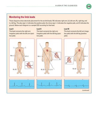 245
A LOOK AT THE 12-LEAD ECG
Monitoring the limb leads
These diagrams show electrode placement for the six limb leads. RA indicates right arm; LA, left arm; RL, right leg; and
LL, left leg. The plus sign (+) indicates the positive pole, the minus sign (–) indicates the negative pole, and G indicates the
ground. Below each diagram is a sample ECG recording for that lead.
Lead I
This lead connects the right arm
(negative pole) with the left arm (posi-
tive pole).
Lead II
This lead connects the right arm
(negative pole) with the left leg (posi-
tive pole).
Lead III
This lead connects the left arm (nega-
tive pole) with the left leg (positive
pole).
RA (–) LA (+)
+
–
RL (G)
I
L (G)
RA (–)
+
–
RL (G) LL (+)
II
RL (G) LL (+)
LA (–)
RL (G) LL (+)
L
L (G) LL (+)
+
–
I
I
I I
(continued)
ECG_Chap11.indd 245
ECG_Chap11.indd 245 7/8/2010 4:33:22 PM
7/8/2010 4:33:22 PM
 